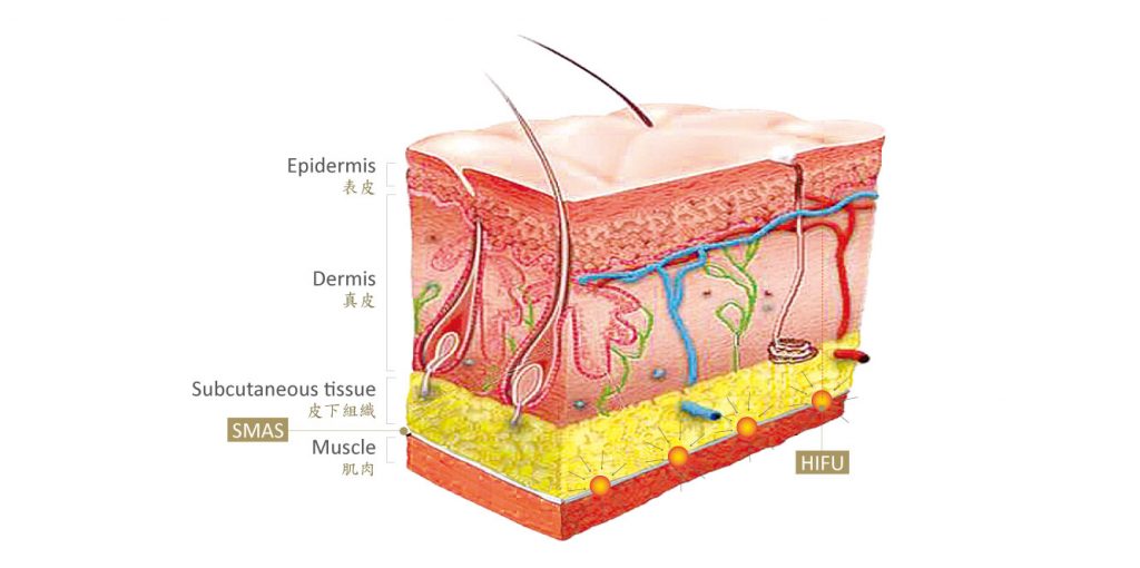 高能聚焦超聲波技術將熱能直達皮下SMAS深層組織