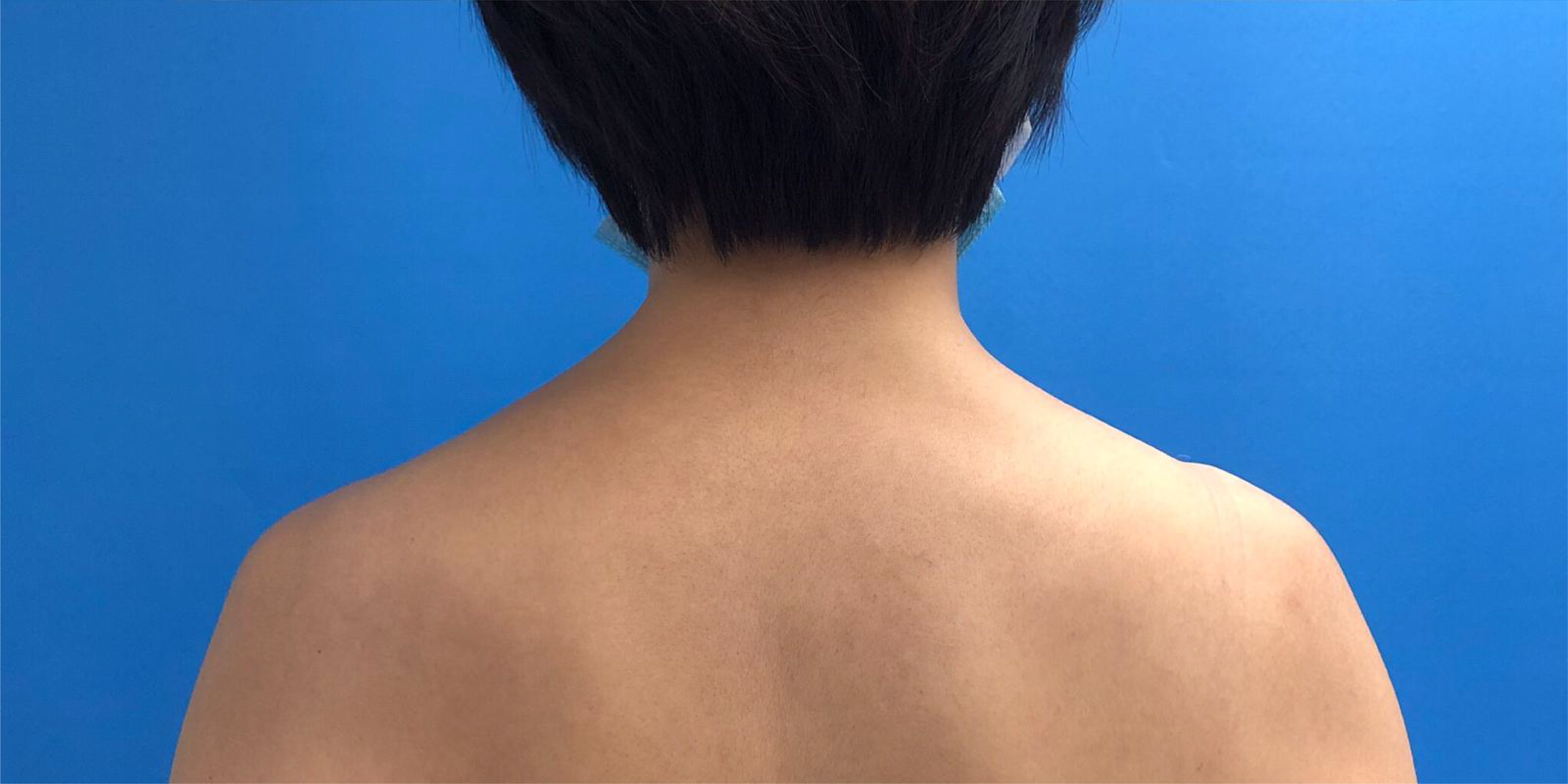 After Xeomin