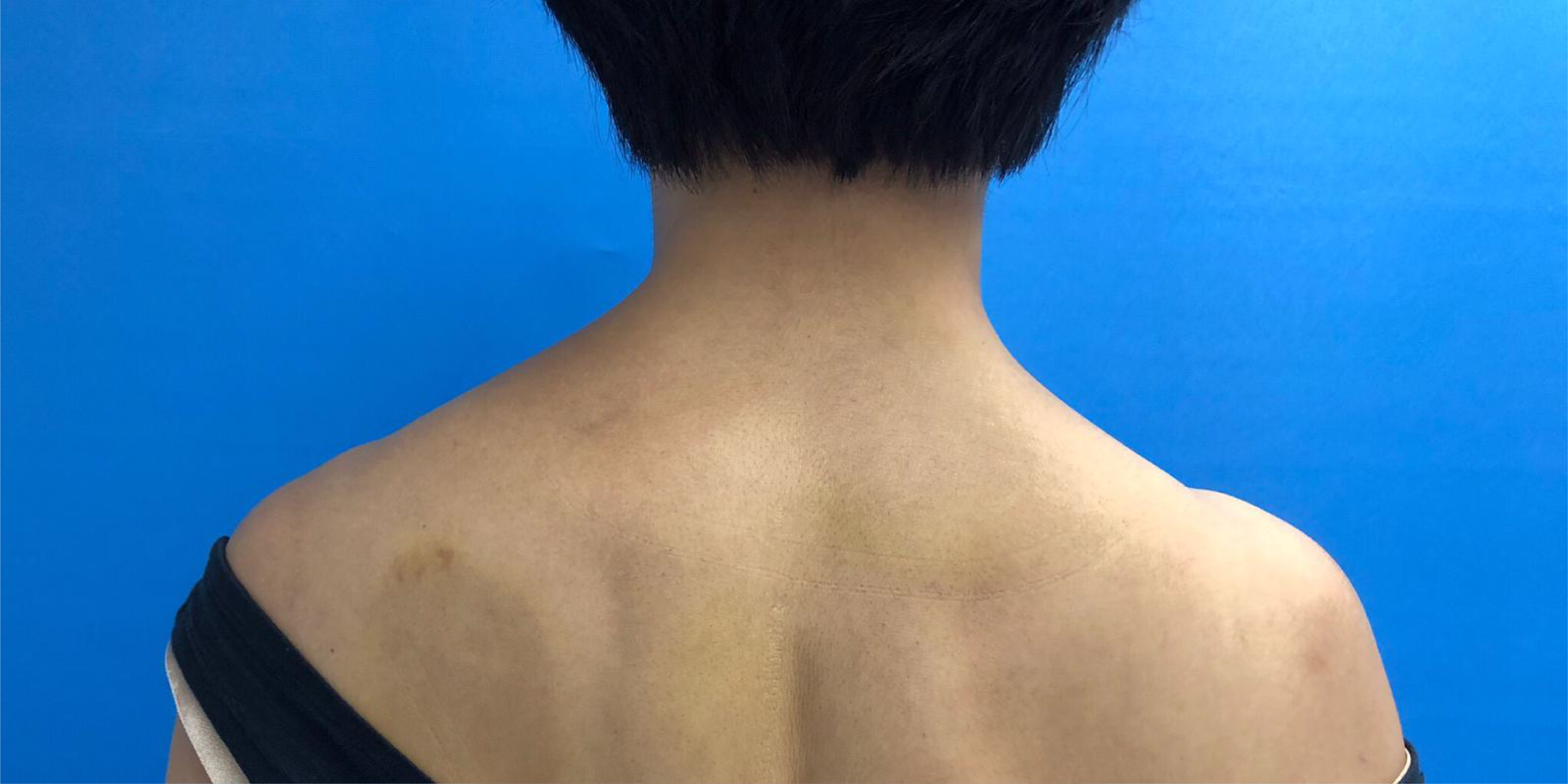 Before Xeomin