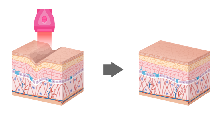 Thermage®️FLX 智能緊膚療程 2 skin 05 768x397 1